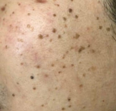 Pico Laser