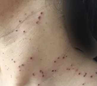 Pico Laser